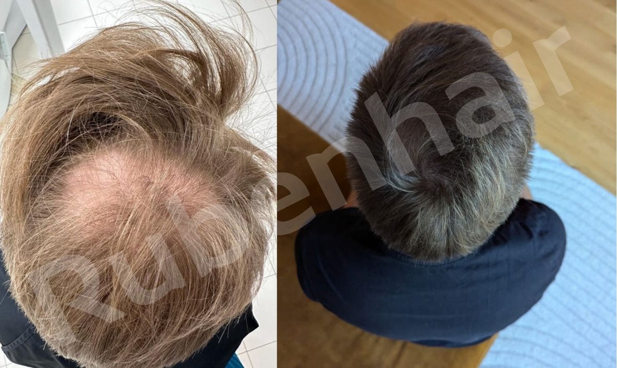 Pealae tiheduse taastamine — Enne / Pärast